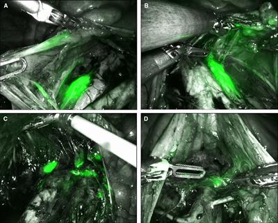 Robotic Staging of Cervical Cancer With Simultaneous Detection of Primary Pelvic and Secondary Para-Aortic Sentinel Lymph Nodes: Reproducibility in a First Case Series